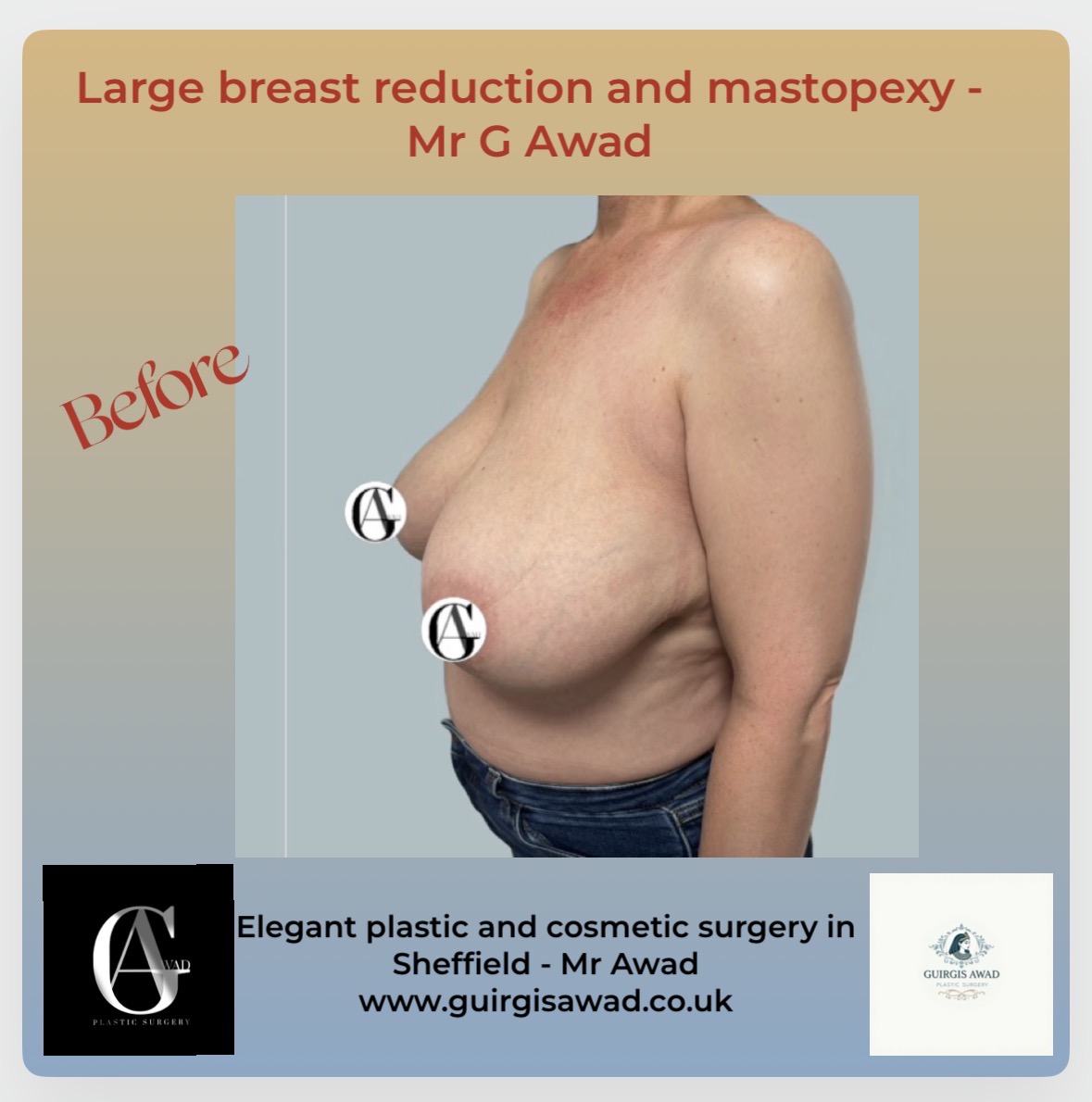 breast reduction before