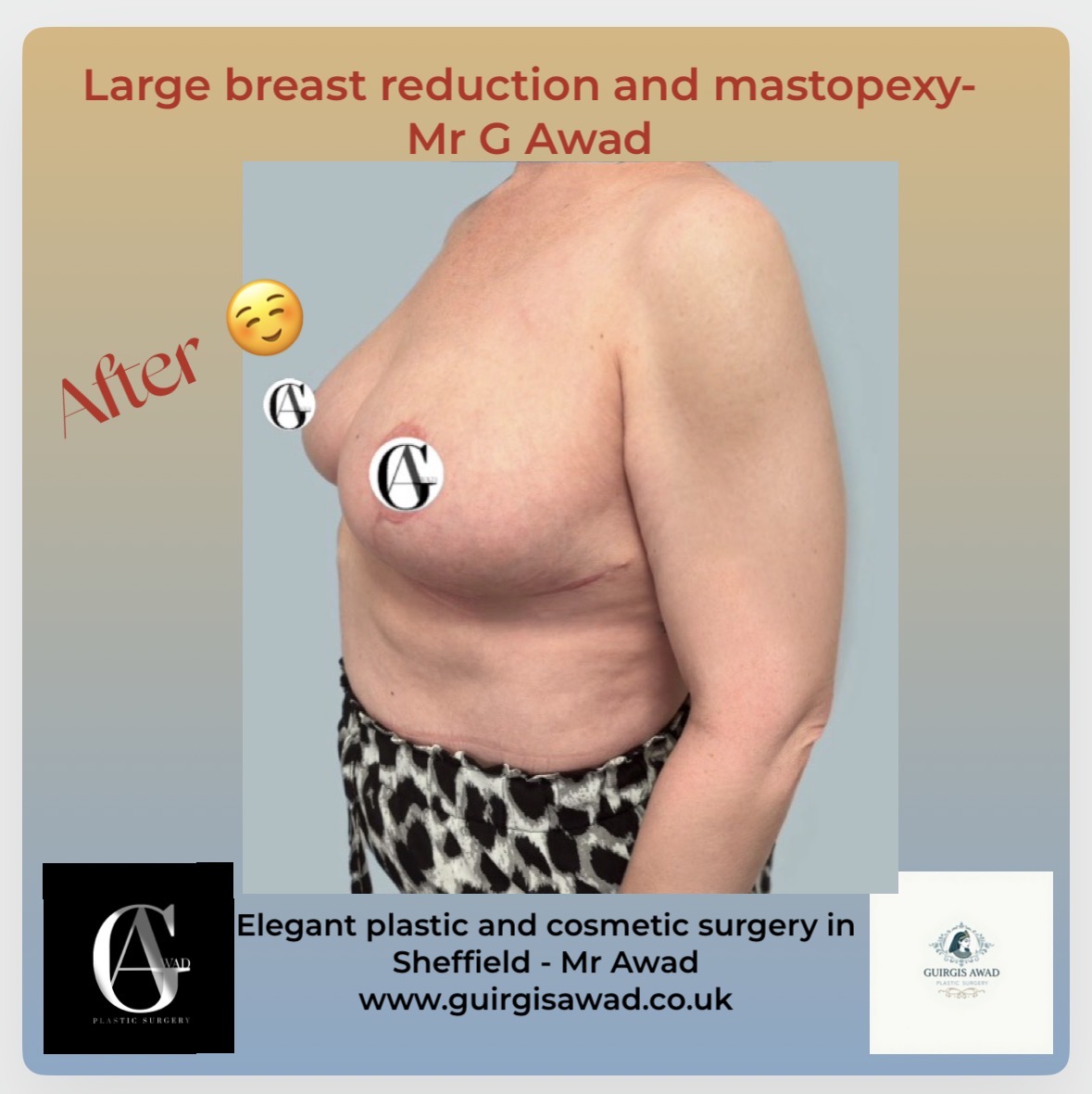 breast reduction after
